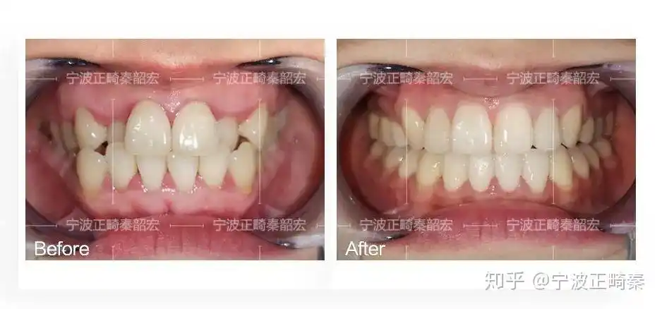 小虎牙要不要矫正