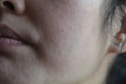 哺乳期妈妈脂溢性皮炎简单治疗