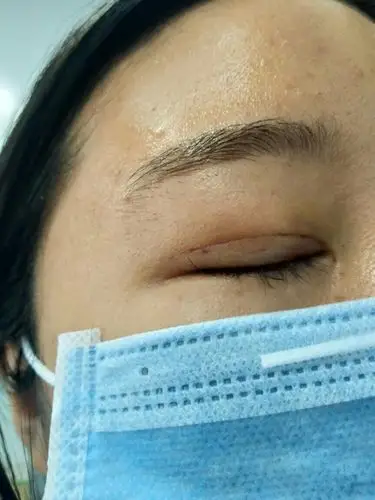 埋线双眼皮第四天 发现眼尾有个很小的小凸起 请专业医生看下是不是
