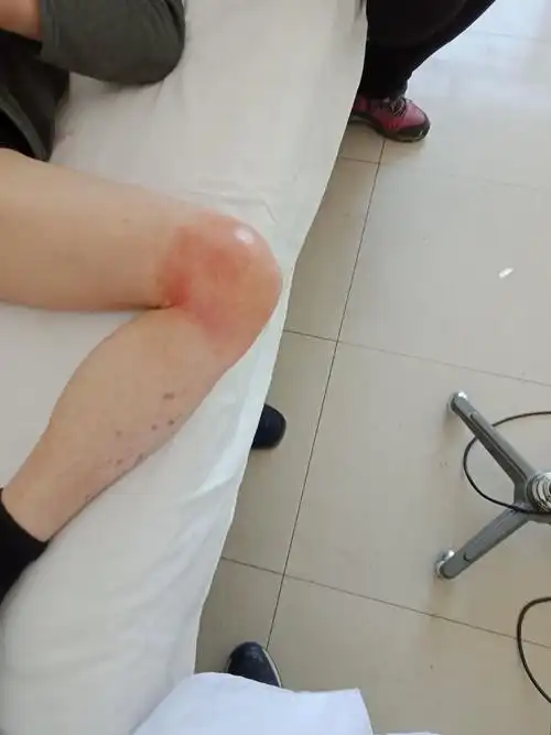 膝关节骨性关节炎,膝关节积液,综合治疗效果显著.