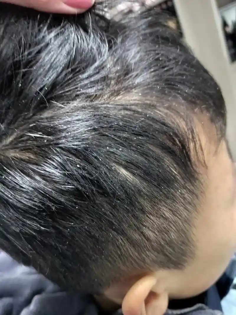 小慧儿子头皮屑治疗图#解决所有头皮头发问题  - 抖音