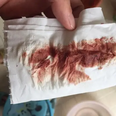 孕早期35天,突然有褐色分泌物,两天了早上很少,下午突然增多,已经吃了