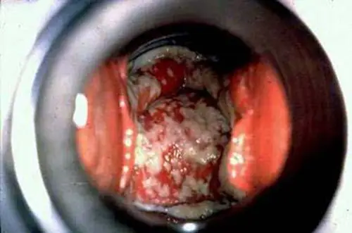 霉菌性阴道炎图片