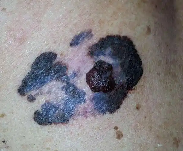 痣上长毛既不是封建迷信说的不祥征兆,也和黑色素瘤的出现没有关系,它