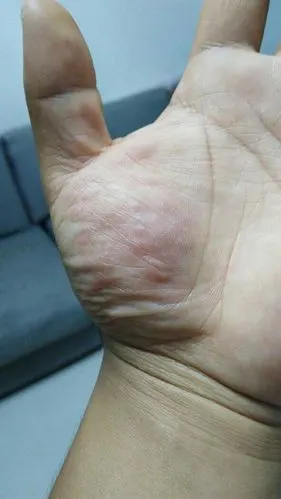 本人有乙肝病,左手起了很多非常痒的红色包,七八天左右就好,小的时候