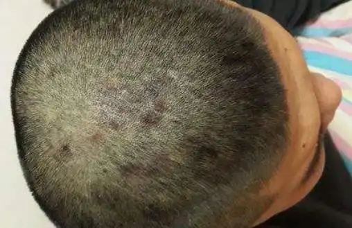 紫癜性湿疹怎样治疗,紫殿性湿疹用什么药膏?