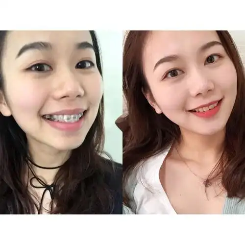 两年749天,戴牙套真的是做的最不后悔的一个决定!