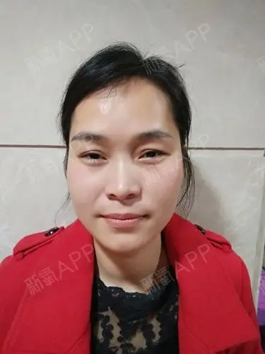 【祛眼袋 自体脂肪填充泪沟术后第113天】我是更新_圈子-新氧美容整形