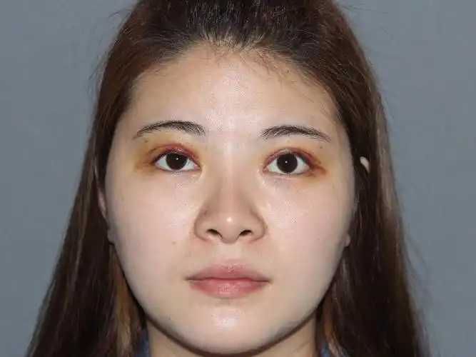 双眼皮修复加脂肪填充术后三天的样子