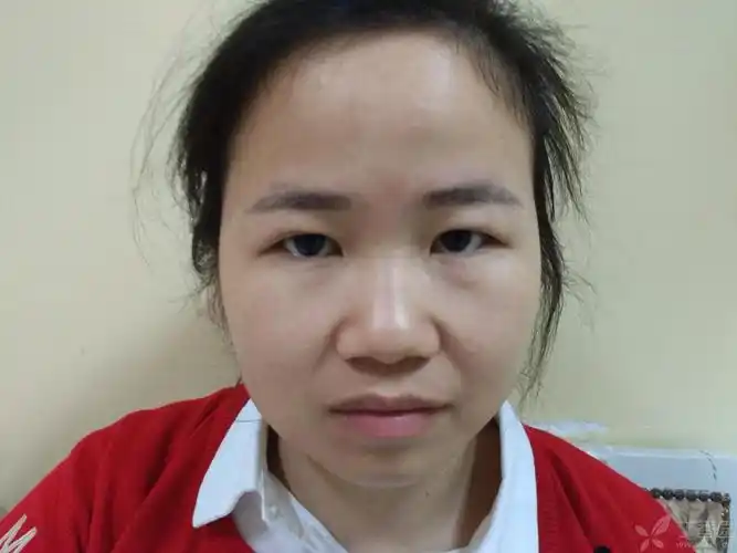 【讨论】术前术中辨别轻度上眼睑下垂在重睑术中的重要性 [精华]