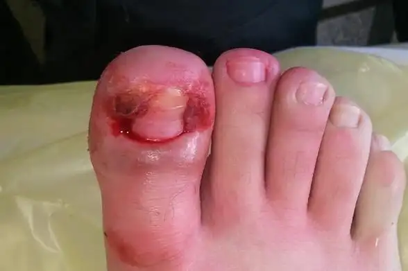 哈尔滨哪家治甲沟炎医院最好 ?