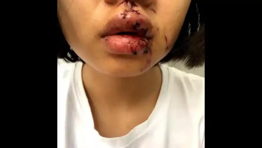 花季女孩被狗咬脸毁容狗主人对赔偿68万元的要求说不律师这样建议