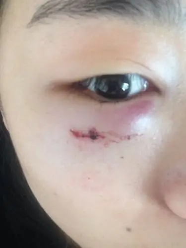 带眼镜撞到墙 上面有一个小伤口 但是颧骨眼袋这边肿起来了 有一个破