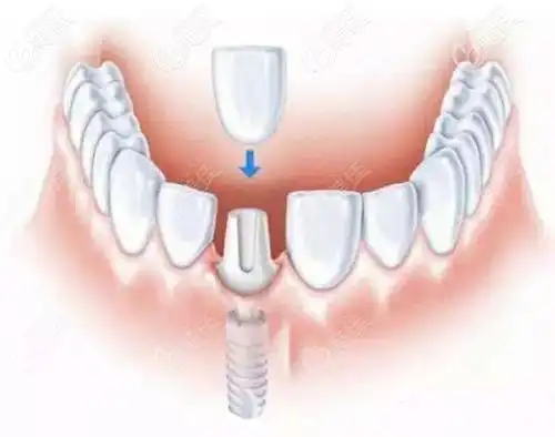 3d数字化导板种植牙的优缺点你知道吗?权衡完利与弊再选择