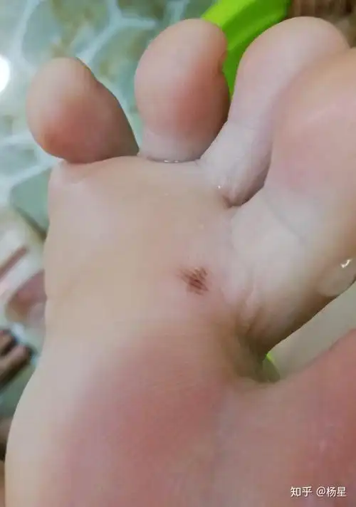 脚底长一个黑点点还不规则给我吓坏了