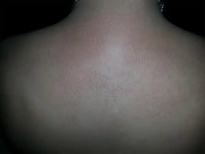 后背长鸡皮疙瘩似的一大块,不痛不痒而且会慢慢扩大!