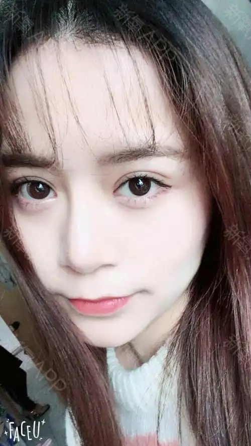 做完双眼皮20天啦~终于由衷熬出头的感觉,都说双眼_圈子-新氧美容整形