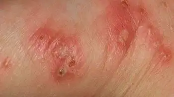 疥疮最初症状表现