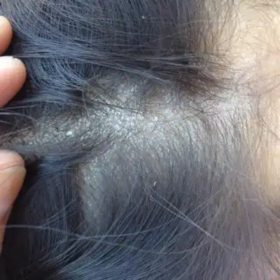 有没有别的办法?不治疗会怎样?