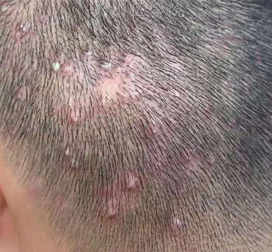 弟弟头上好多这样的疙瘩,去医院检查是毛囊炎,吃了很多药不显好.