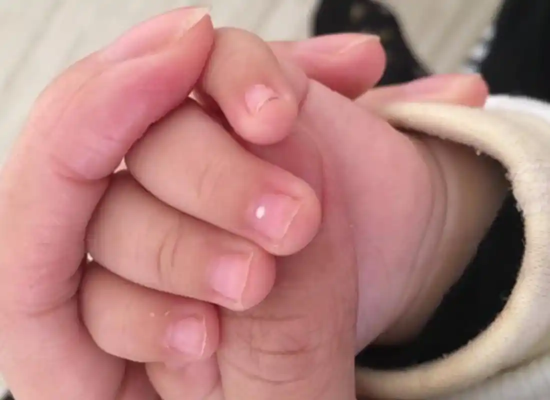 指甲上的小白点,在医学上有一个名词叫"点状白甲",大人小孩都会出现