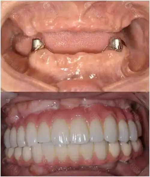 穿颧穿翼全口种植牙前后效果对比