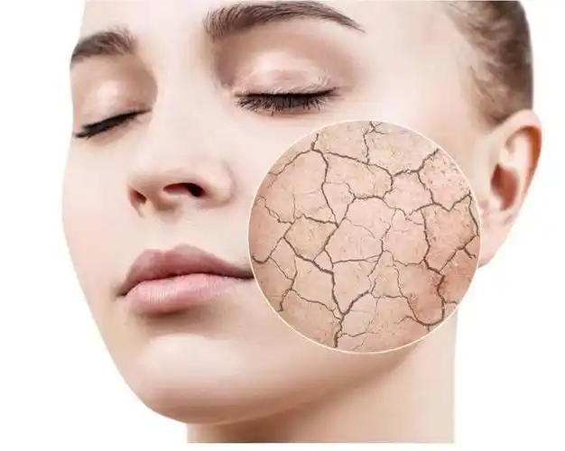 冬季,皮肤为什么会容易干燥缺水?一起来看看原因