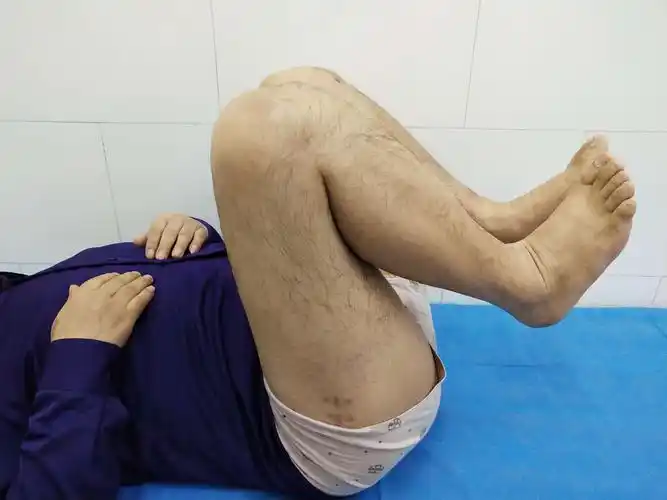 屈髋屈膝功能完全正常.双下肢功能恢复非常好.