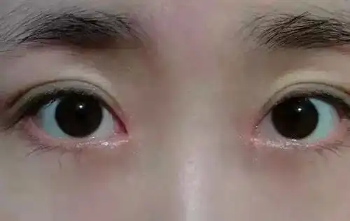 睑内翻【多图】_39医疗图集-39健康网