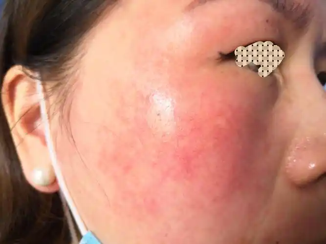 面部红斑红血丝治疗案例