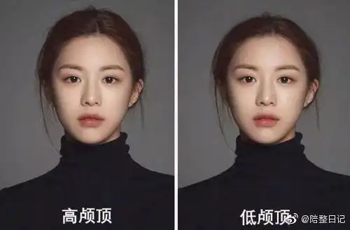 高低颅顶的对比