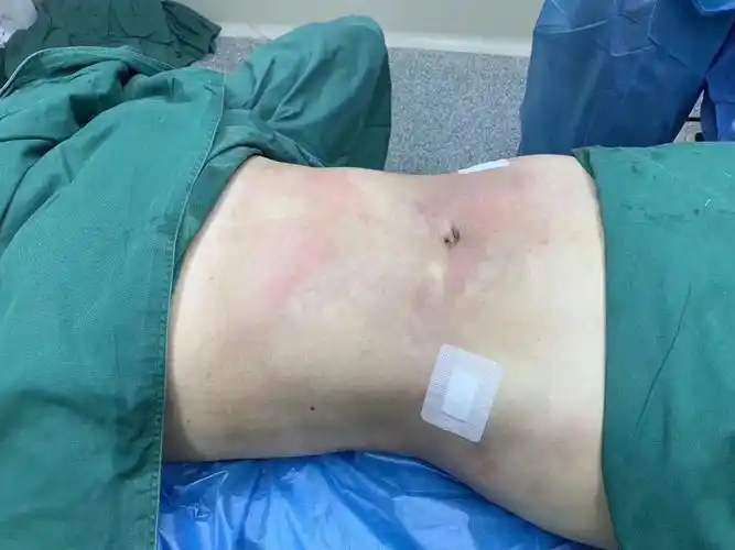 腰腹环吸术后即刻对比~ 颜值社会~胜在执行~输在犹_圈子-新氧美容整形