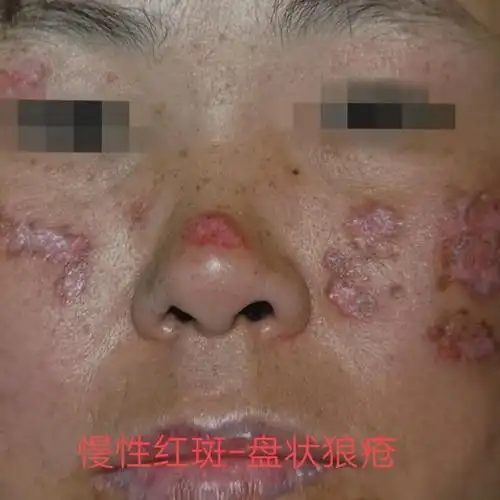 什么是狼疮性脂膜炎应该如何治疗