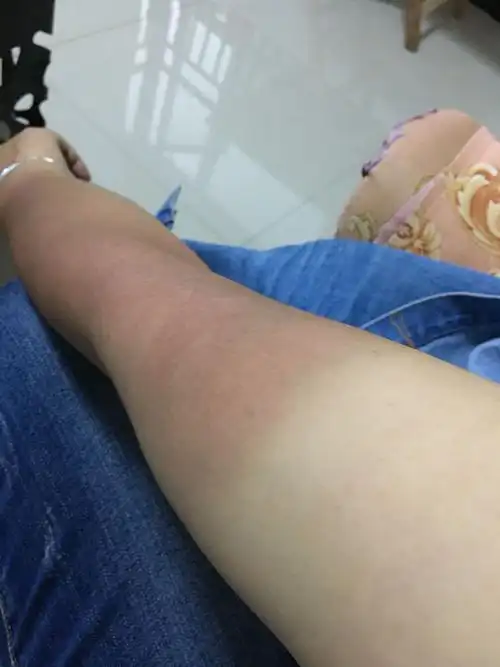 去抚仙湖玩了一天就晒黑了非常严重,好几天了皮肤好又疼又痒的.