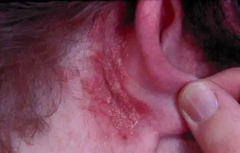 婴儿外耳湿疹会怎么样