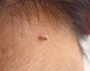 颈部长丝状疣在江门还是去广州的医院治疗比较好?_百度知道