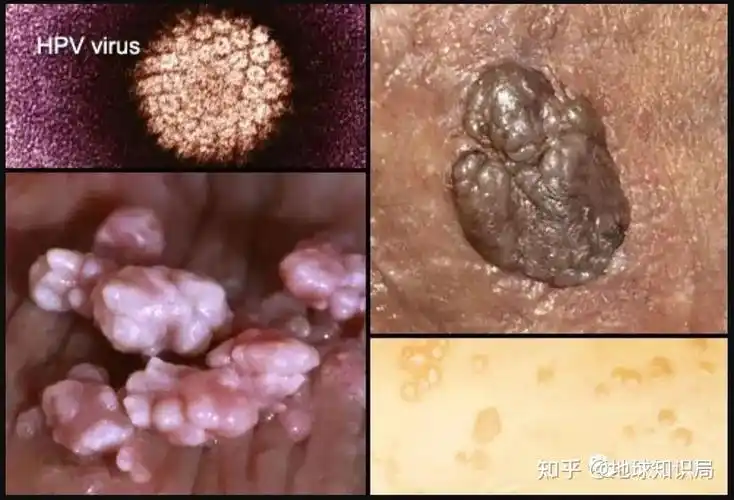 前文提到的生殖器疣,还有一个更广为人知的名字——尖锐湿疣,也即是