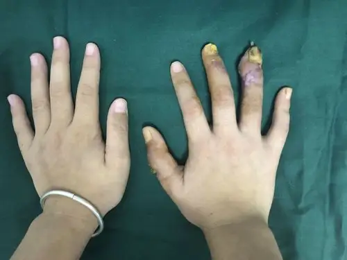 "近日,三亚市人民医院骨显微外科团队通过手指再造手术,成功为一名环