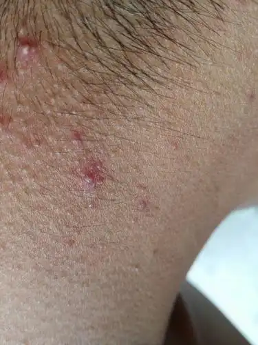 长在右后颈子上的已经好多天了请问是怎么回事,谢谢