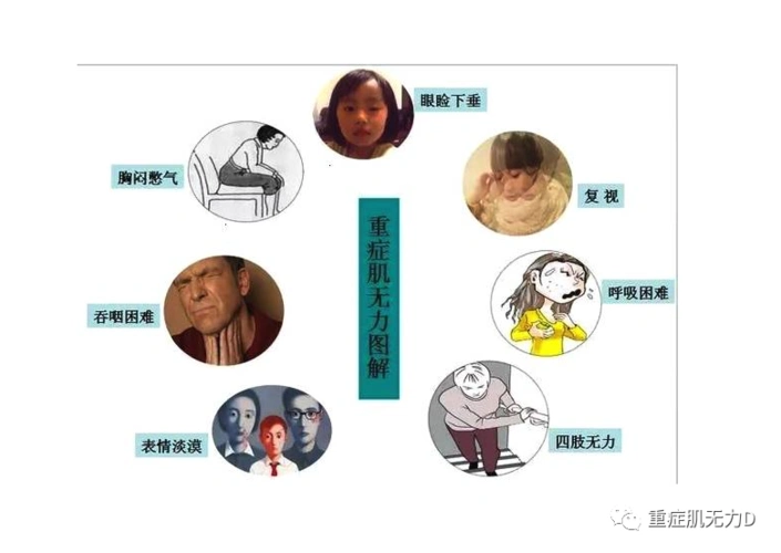 深受眼肌型重症肌无力困扰的你该怎么办