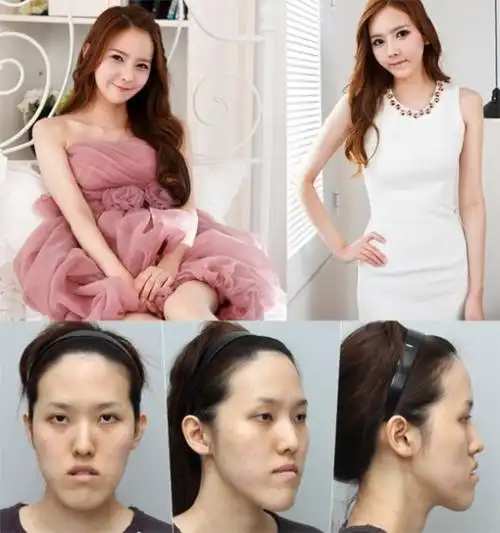 曾出演整容节目《let美人》的"胸部凹陷女"沈有罗(音)的近况曝光.