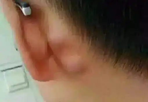 育儿百科-宝宝耳朵后面长了个疙瘩是怎么回事?__凤凰网