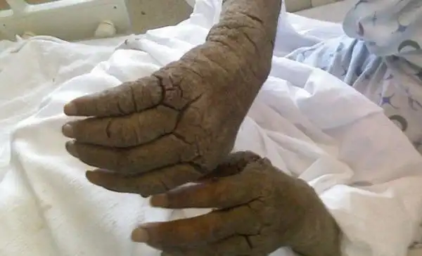 全球十大最恐怖的寄生虫 胆小勿入真的很渗人