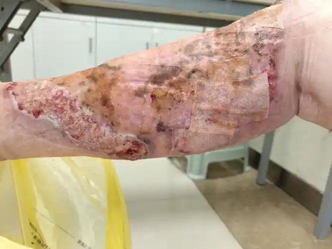 11.14陆瑞红右下肢皮肤溃疡第一次门诊换药记