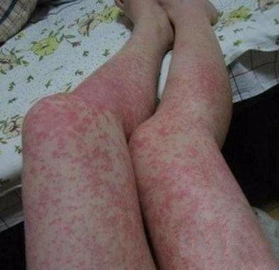 发痒与皮肤红肿一样,发痒也只是大部分过敏性皮炎,会有的症状.