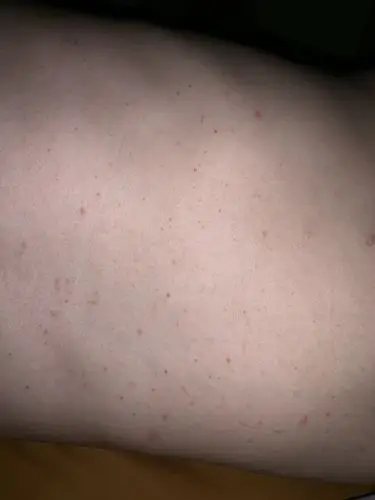 皮肤上出现红点