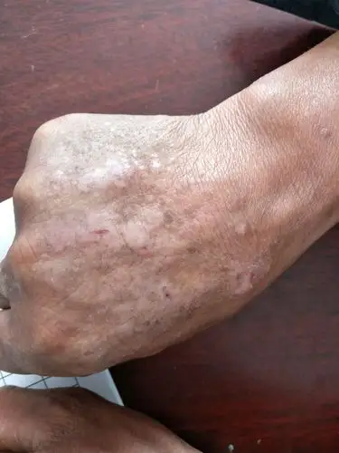 慢性日光性皮炎(慢光化)