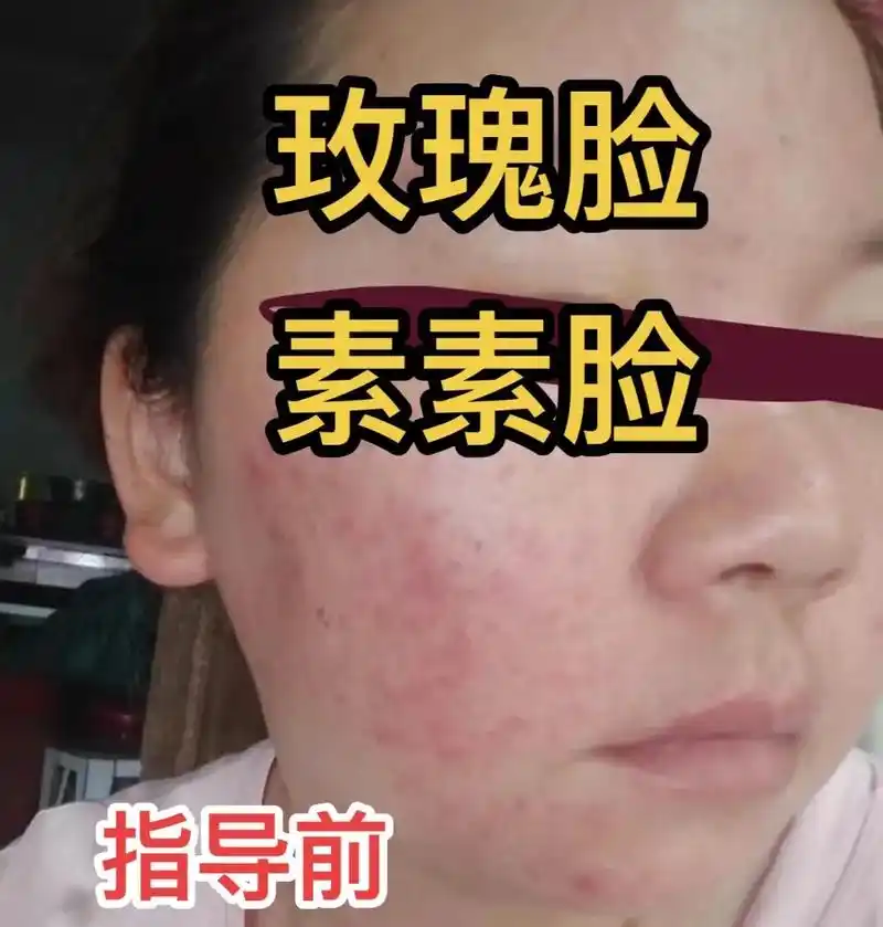 玫瑰素素脸修复的全过程!抵抗力不太好皮肤恢复的慢,脸轻脸重的 - 抖