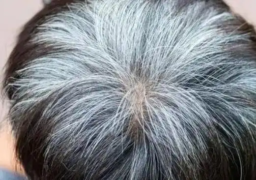 随着年龄的不断增长,人们的头上就会出现一些白发,这也是变老的特征之