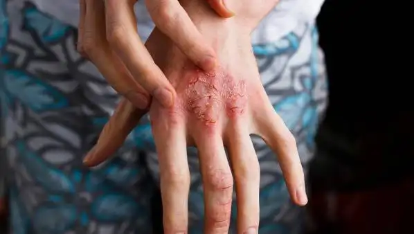 鱼鳞病就是其中一种,虽然对人体的伤害不大,但严重情况下会影响美观